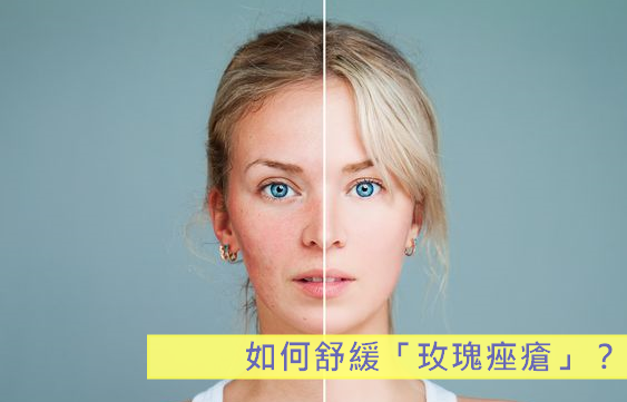 Rosacea 11