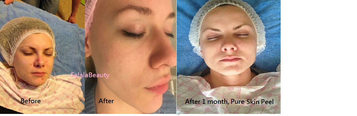 peel skin ba