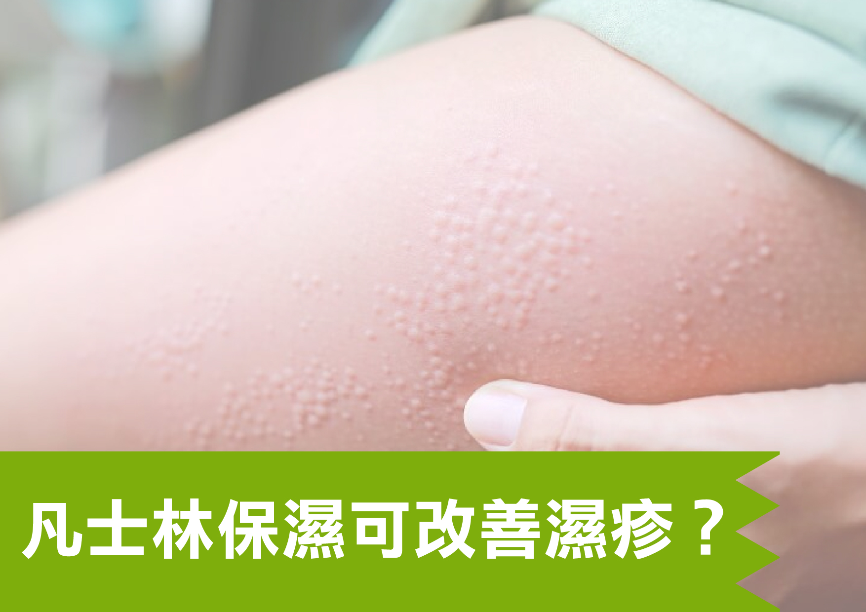 凡士林保濕可改善濕疹 01
