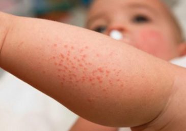 eczema