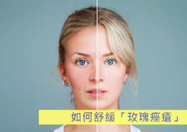 如何舒緩「玫瑰痤瘡」！？